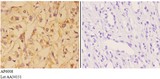 VNN1 Antibody - Immunohistochemistry (IHC) analysis of VNN1 antibody in paraffin-embedded human kidney carcinoma tissue at 1:50, showing cytoplasm and membrane staining. Negative control (the right) using PBS instead of primary antibody. Secondary antibody is Goat Anti-Rabbit Ig.