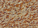VPS33A Antibody - Immunohistochemistry of paraffin-embedded human liver cancer using VPS33A Antibody at dilution of 1:100