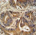 VPS52 / SACM2L Antibody - VPS52 antibody immunohistochemistry of formalin-fixed and paraffin-embedded human colon carcinoma followed by peroxidase-conjugated secondary antibody and DAB staining.
