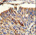 VTI1A Antibody - Formalin-fixed and paraffin-embedded human lung carcinoma with VTI1A Antibody , which was peroxidase-conjugated to the secondary antibody, followed by DAB staining. This data demonstrates the use of this antibody for immunohistochemistry; clinical relevance has not been evaluated.