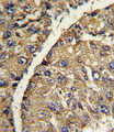 VTN / Vitronectin Antibody - Formalin-fixed and paraffin-embedded human hepatocarcinoma with VTN Antibody , which was peroxidase-conjugated to the secondary antibody, followed by DAB staining. This data demonstrates the use of this antibody for immunohistochemistry; clinical relevance has not been evaluated.