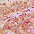 WDHD1 Antibody - Immunohistochemical analysis of WDHD1 staining in human breast cancer formalin fixed paraffin embedded tissue section. The section was pre-treated using heat mediated antigen retrieval with sodium citrate buffer (pH 6.0). The section was then incubated with the antibody at room temperature and detected using an HRP conjugated compact polymer system. DAB was used as the chromogen. The section was then counterstained with hematoxylin and mounted with DPX.