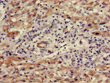 WDR19 Antibody - Immunohistochemistry of paraffin-embedded human liver cancer using WDR19 Antibody at dilution of 1:100