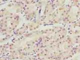 WDR34 Antibody - Immunohistochemistry of paraffin-embedded human gastric cancer using antibody at dilution of 1:100.