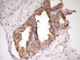 WDR61 Antibody - IHC of paraffin-embedded Carcinoma of Human prostate tissue using anti-WDR61 mouse monoclonal antibody. (Heat-induced epitope retrieval by 1 mM EDTA in 10mM Tris, pH8.5, 120°C for 3min).