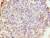 WDR62 Antibody - Immunohistochemistry of paraffin-embedded human bladder carcinoma using antibody at dilution of 1:100.