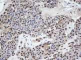 WDR74 Antibody - IHC of paraffin-embedded Carcinoma of Human pancreas tissue using anti-WDR74 mouse monoclonal antibody. (Heat-induced epitope retrieval by 10mM citric buffer, pH6.0, 100C for 10min).