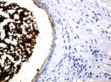 WFDC2 / HE4 Antibody - IHC of paraffin-embedded Carcinoma of Human prostate tissue using anti-WFDC2 mouse monoclonal antibody.