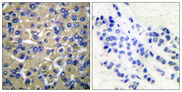 WNK1 Antibody - Immunohistochemistry analysis of paraffin-embedded human breast carcinoma tissue, using WNK1 Antibody. The picture on the right is blocked with the synthesized peptide.