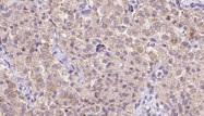 WSB1 Antibody - 1:100 staining human thyroid carcinoma tissue by IHC-P. The sample was formaldehyde fixed and a heat mediated antigen retrieval step in citrate buffer was performed. The sample was then blocked and incubated with the antibody for 1.5 hours at 22°C. An HRP conjugated goat anti-rabbit antibody was used as the secondary.