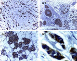 XIAP Antibody - IHC of XIAP in formalin-fixed, paraffin-embedded human breast carcinoma using Polyclonal Antibody to XIAP at 1:2000. A-A3, successively higher magnifications of the breast carcinoma tissue section. Hematoxylin-Eosin counterstain.