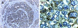 XIAP Antibody - IHC of XIAP in formalin-fixed, paraffin-embedded human small cell lung carcinoma using Polyclonal Antibody to XIAP at 1:2000. A, low magnification. A1, high magnification. Hematoxylin-Eosin counterstain.
