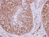 XPO6 Antibody - IHC of paraffin-embedded Breast ca, using XPO6 antibody at 1:250 dilution.