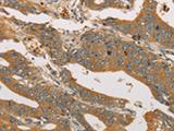 XPR1 Antibody - Immunohistochemistry of paraffin-embedded Human gastric cancer tissue  using XPR1 Polyclonal Antibody at dilution of 1:45(×200)