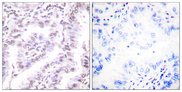XRCC5 / Ku80 Antibody - Immunohistochemistry analysis of paraffin-embedded human lung carcinoma tissue, using Ku80 Antibody. The picture on the right is blocked with the synthesized peptide.