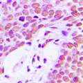 XRCC5 / Ku80 Antibody - Immunohistochemical analysis of Ku80 staining in human breast cancer formalin fixed paraffin embedded tissue section. The section was pre-treated using heat mediated antigen retrieval with sodium citrate buffer (pH 6.0). The section was then incubated with the antibody at room temperature and detected using an HRP conjugated compact polymer system. DAB was used as the chromogen. The section was then counterstained with hematoxylin and mounted with DPX.