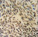 XRCC6 / Ku70 Antibody - XRCC6 Antibody IHC of formalin-fixed and paraffin-embedded human lung carcinoma followed by peroxidase-conjugated secondary antibody and DAB staining.