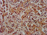 XRG8 / XKR8 Antibody - Immunohistochemistry Dilution at 1:1000 and staining in paraffin-embedded human liver cancer performed on a Leica BondTM system. After dewaxing and hydration, antigen retrieval was mediated by high pressure in a citrate buffer (pH 6.0). Section was blocked with 10% normal Goat serum 30min at RT. Then primary antibody (1% BSA) was incubated at 4°C overnight. The primary is detected by a biotinylated Secondary antibody and visualized using an HRP conjugated SP system.