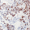 XRN2 Antibody - Immunohistochemical analysis of XRN2 staining in human breast cancer formalin fixed paraffin embedded tissue section. The section was pre-treated using heat mediated antigen retrieval with sodium citrate buffer (pH 6.0). The section was then incubated with the antibody at room temperature and detected using an HRP conjugated compact polymer system. DAB was used as the chromogen. The section was then counterstained with hematoxylin and mounted with DPX.
