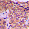 YAP / YAP1 Antibody - Immunohistochemical analysis of YAP1 staining in human breast cancer formalin fixed paraffin embedded tissue section. The section was pre-treated using heat mediated antigen retrieval with sodium citrate buffer (pH 6.0). The section was then incubated with the antibody at room temperature and detected using an HRP conjugated compact polymer system. DAB was used as the chromogen. The section was then counterstained with hematoxylin and mounted with DPX.