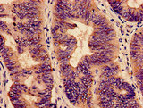 YBEY / C21orf57 Antibody - Immunohistochemistry analysis of human colon cancer at a dilution of 1:100