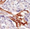 YES1 / c-Yes Antibody - Formalin-fixed and paraffin-embedded human cancer tissue reacted with the primary antibody, which was peroxidase-conjugated to the secondary antibody, followed by AEC staining. This data demonstrates the use of this antibody for immunohistochemistry; clinical relevance has not been evaluated. BC = breast carcinoma; HC = hepatocarcinoma.