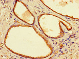 YIPF6 Antibody - Immunohistochemistry of paraffin-embedded human prostate cancer using YIPF6 Antibody at dilution of 1:100