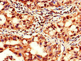 YTHDF2 Antibody - Immunohistochemistry of paraffin-embedded human lung cancer using YTHDF2 Antibody at dilution of 1:100