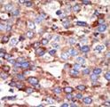 YY1 Antibody - Formalin-fixed and paraffin-embedded human cancer tissue reacted with the primary antibody, which was peroxidase-conjugated to the secondary antibody, followed by DAB staining. This data demonstrates the use of this antibody for immunohistochemistry; clinical relevance has not been evaluated. BC = breast carcinoma; HC = hepatocarcinoma.