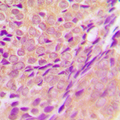 ZADH2 Antibody - Immunohistochemical analysis of ZADH2 staining in human breast cancer formalin fixed paraffin embedded tissue section. The section was pre-treated using heat mediated antigen retrieval with sodium citrate buffer (pH 6.0). The section was then incubated with the antibody at room temperature and detected using an HRP conjugated compact polymer system. DAB was used as the chromogen. The section was then counterstained with hematoxylin and mounted with DPX.