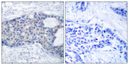 ZAP70 Antibody - Immunohistochemistry analysis of paraffin-embedded human breast carcinoma, using ZAP-70 (Phospho-Tyr493) Antibody. The picture on the right is blocked with the phospho peptide.