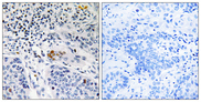 ZBTB40 Antibody - Immunohistochemistry analysis of paraffin-embedded human lung carcinoma tissue, using ZBTB40 Antibody. The picture on the right is blocked with the synthesized peptide.