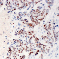 ZC3H4 Antibody - Immunohistochemical analysis of ZC3H4 staining in human breast cancer formalin fixed paraffin embedded tissue section. The section was pre-treated using heat mediated antigen retrieval with sodium citrate buffer (pH 6.0). The section was then incubated with the antibody at room temperature and detected using an HRP conjugated compact polymer system. DAB was used as the chromogen. The section was then counterstained with hematoxylin and mounted with DPX.