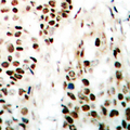 ZC3HC1 / NIPA Antibody - Immunohistochemical analysis of NIPA staining in human breast cancer formalin fixed paraffin embedded tissue section. The section was pre-treated using heat mediated antigen retrieval with sodium citrate buffer (pH 6.0). The section was then incubated with the antibody at room temperature and detected using an HRP conjugated compact polymer system. DAB was used as the chromogen. The section was then counterstained with hematoxylin and mounted with DPX.