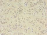 ZDHHC4 Antibody - Immunohistochemistry of paraffin-embedded human liver cancer using antibody at dilution of 1:100.