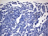 ZEB2 / SIP-1 Antibody - IHC of paraffin-embedded Human lymphoma tissue using anti-ZEB2 mouse monoclonal antibody.