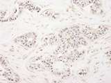 ZFPM1 / FOG1 Antibody - Detection of Human FOG1/ZFPM1 by Immunohistochemistry. Sample: FFPE section of human breast carcinoma. Antibody: Affinity purified rabbit anti-FOG1/ZFPM1 used at a dilution of 1:250.