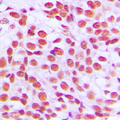 ZIF268 / EGR1 Antibody - Immunohistochemical analysis of EGR1 staining in human breast cancer formalin fixed paraffin embedded tissue section. The section was pre-treated using heat mediated antigen retrieval with sodium citrate buffer (pH 6.0). The section was then incubated with the antibody at room temperature and detected using an HRP conjugated compact polymer system. DAB was used as the chromogen. The section was then counterstained with hematoxylin and mounted with DPX.