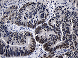 ZKSCAN1 / ZNF36 Antibody - Immunohistochemical staining of paraffin-embedded Adenocarcinoma of Human colon tissue using anti-ZKSCAN1 mouse monoclonal antibody. (Heat-induced epitope retrieval by 1mM EDTA in 10mM Tris buffer. (pH8.5) at 120°C for 3 min. (1:500)