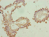 ZNF184 Antibody - Immunohistochemistry of paraffin-embedded human breast cancer using ZNF184 Antibody at dilution of 1:100