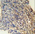 ZNF197 Antibody - ZNF197 antibody immunohistochemistry of formalin-fixed and paraffin-embedded human lung carcinoma followed by peroxidase-conjugated secondary antibody and DAB staining.