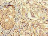ZNF2 Antibody - Paraffin-embedding Immunohistochemistry using human pancreatic cancer at dilution 1:100