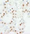 ZNF318 Antibody - Detection of Human ZNF318/TZF by Immunohistochemistry. Sample: FFPE section of human thyroid carcinoma. Antibody: Affinity purified rabbit anti-ZNF318/TZF used at a dilution of 1:1000 (1 ug/ml). Detection: DAB.