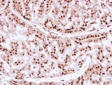 ZNF323 Antibody - IHC of paraffin-embedded Breast ca, using ZNF323 antibody at 1:250 dilution.
