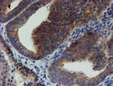 ZNF365 Antibody - IHC of paraffin-embedded Adenocarcinoma of Human endometrium tissue using anti-ZNF365 mouse monoclonal antibody.