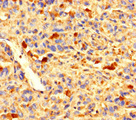 ZNF384 Antibody - Immunohistochemistry of paraffin-embedded human melanoma using ZNF384 Antibody at dilution of 1:100
