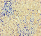 ZNF404 Antibody - Immunohistochemistry of paraffin-embedded human liver cancer using ZNF404 Antibody at dilution of 1:100