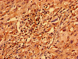 ZNF529 Antibody - Immunohistochemistry analysis of human lung cancer using ZNF529 Antibody at dilution of 1:100