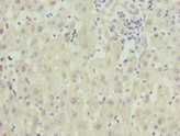 ZNF544 Antibody - Immunohistochemistry of paraffin-embedded human liver cancer at dilution 1:100