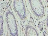 ZNF555 Antibody - Immunohistochemistry of paraffin-embedded human colon cancer using antibody at dilution of 1:100.